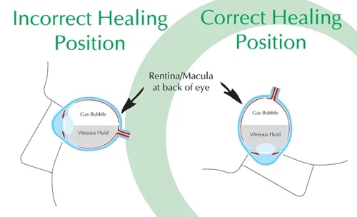 Diagram showing incorrect and correct healing position after vitrectomy